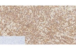 Immunohistochemistry of paraffin-embedded Human breast cancer tissue using Phospho-Catenin beta (Ser37) Polyclonal Antibody at dilution of 1:200 (beta Catenin Antikörper  (pSer37))
