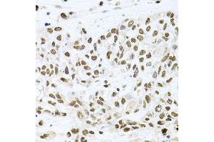 Immunohistochemistry of paraffin-embedded human lung cancer using BCCIP antibody (ABIN5995871) at dilution of 1/100 (40x lens). (BCCIP Antikörper)