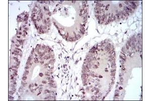 Immunohistochemical analysis of paraffin-embedded colon cancer tissues using HOXB4 mouse mAb with DAB staining. (HOXB4 Antikörper  (AA 16-251))