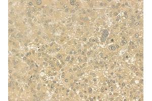 ABIN6262303 and ABIN6276781 at 1/100 staining human hepatocellular carcinoma by IHC-P. (HMGCR Antikörper  (N-Term))