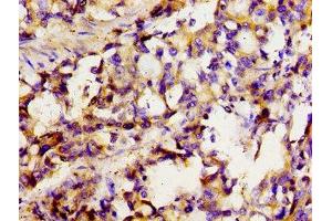 Immunohistochemistry of paraffin-embedded human gastric cancer using ABIN7170131 at dilution of 1:100 (SLC22A1 Antikörper  (AA 43-149))