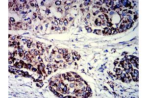 Immunohistochemical analysis of paraffin-embedded ovarian cancer tissues using PIGR mouse mAb with DAB staining.