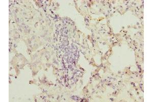 Immunohistochemistry of paraffin-embedded human lung cancer using ABIN7174654 at dilution of 1:100 (OGT Antikörper  (AA 606-1022))
