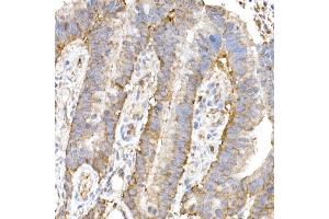 Immunohistochemistry of paraffin-embedded human colon carcinoma using MK4 Rabbit mAb (ABIN7268653) at dilution of 1:50 (40x lens). (MAP3K4 Antikörper)
