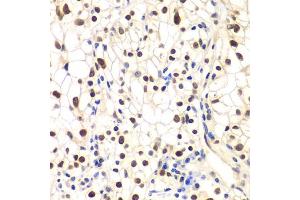 Immunohistochemistry of paraffin-embedded human kidney cancer using NFKBIB antibody (ABIN6130475, ABIN6144584, ABIN6144585 and ABIN6221459) at dilution of 1:200 (40x lens). (NFKBIB Antikörper  (AA 1-356))