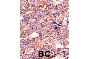 Immunohistochemistry (Formalin/PFA-fixed paraffin-embedded sections) of human breast carcinoma with Histone H3 (phospho S10) polyclonal antibody , followed by peroxidase-conjugated secondary antibody and AEC staining.
