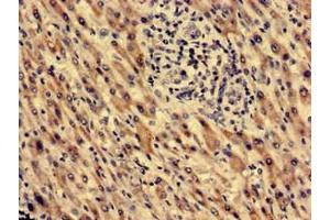 Immunohistochemistry analysis of human liver cancer using ABIN7172382 at dilution of 1:100 (MECR Antikörper  (AA 211-373))
