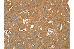The image on the left is immunohistochemistry of paraffin-embedded Human ovarian cancer tissue using ABIN7131067(SIRT4 Antibody) at dilution 1/25. (SIRT4 Antikörper)