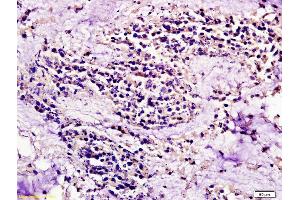 Formalin-fixed and paraffin embedded human colon carcinoma labeled with Anti CCR7/CD197 Polyclonal Antibody, Unconjugated (ABIN674724) at 1:200 followed by conjugation to the secondary antibody and DAB staining (CCR7 Antikörper  (AA 25-59))