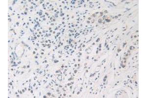 IHC-P analysis of Human Stomach Cancer Tissue, with DAB staining. (FDFT1 Antikörper  (AA 269-417))