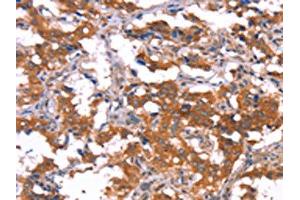 The image on the left is immunohistochemistry of paraffin-embedded Human thyroid cancer tissue using ABIN7190910(HCAR2 Antibody) at dilution 1/40, on the right is treated with synthetic peptide. (HCAR2 Antikörper)