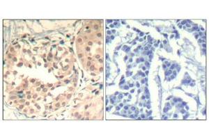Immunohistochemical analysis of paraffin-embedded human breast carcinoma tissue using CDK6(Phospho-Tyr13) Antibody(left) or the same antibody preincubated with blocking peptide(right). (CDK6 Antikörper  (pTyr13))