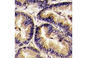 IHC analysis of FFPE human lung carcinoma tissue stained with VEGFB antibody (VEGFB (VEGF2) (AA 110-139) Antikörper)