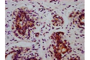 IHC image of ABIN7127690 diluted at 1:100 and staining in paraffin-embedded human breast cancer performed on a Leica BondTM system. (Rekombinanter EIF2S1 Antikörper  (pSer51))