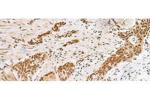 Immunohistochemistry of paraffin-embedded Human esophagus cancer tissue using PNRC2 Polyclonal Antibody at dilution of 1:30(x200) (PNRC2 Antikörper)