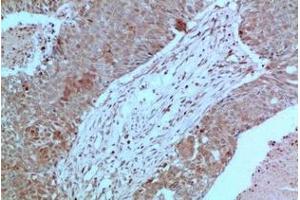 Immunohistochemistry of paraffin-embedded Human breast carcinoma tissue using JAK2 Monoclonal Antibody at dilution of 1:200. (JAK2 Antikörper)