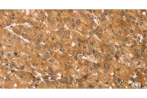 Immunohistochemistry of paraffin-embedded Human liver cancer tissue using SNAP29 Polyclonal Antibody at dilution 1:45 (SNAP29 Antikörper)
