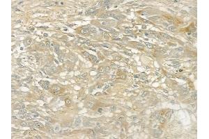 ABIN6260440 and ABIN6272875 at 1/100 staining human tongue carcinoma by IHC-P. (CAMSAP2 Antikörper  (C-Term))