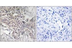 Immunohistochemistry analysis of paraffin-embedded human liver carcinoma tissue, using Cytochrome P450 4Z1 Antibody. (CYP4Z1 Antikörper  (AA 71-120))