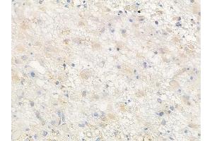 ABIN6258728 and ABIN6274565 at 1/100 staining human astrocytoma by IHC-P.