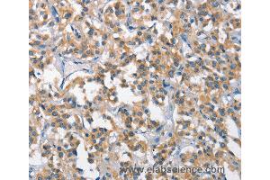 Immunohistochemistry of Human gastric cancer using SCARB1 Polyclonal Antibody at dilution of 1:65 (SCARB1 Antikörper)