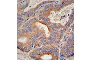 Immunohistochemistry analysis in formalin fixed and paraffin embedded human prostate carcinoma reacted with GLB1L2 Antibody (C-term) followed by peroxidase conjugation of the secondary antibody and DAB staining. (GLB1L2 Antikörper  (C-Term))