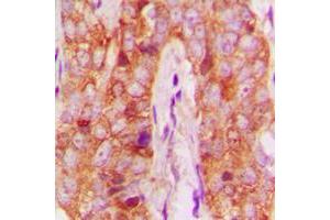 Immunohistochemical analysis of MMP13 staining in human breast cancer formalin fixed paraffin embedded tissue section. (MMP13 Antikörper  (N-Term))