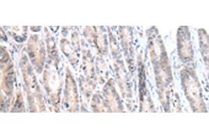 Immunohistochemistry of paraffin-embedded Human gastric cancer tissue using CALB2 Polyclonal Antibody at dilution of 1:25(x200) (Calretinin Antikörper)