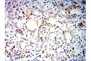 Immunohistochemical analysis of paraffin-embedded cervical cancer tissues using PGR mouse mAb with DAB staining. (Progesterone Receptor Antikörper  (AA 166-411))