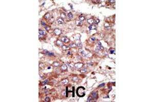 Formalin-fixed and paraffin-embedded human hepatocellular carcinoma tissue reacted with the ACSL6 polyclonal antibody  , which was peroxidase-conjugated to the secondary antibody, followed by AEC staining. (ACSL6 Antikörper  (Internal Region))