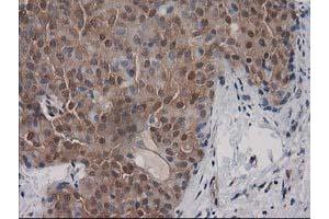 Immunohistochemical staining of paraffin-embedded Adenocarcinoma of Human breast tissue using anti-DSTN mouse monoclonal antibody. (Destrin Antikörper)