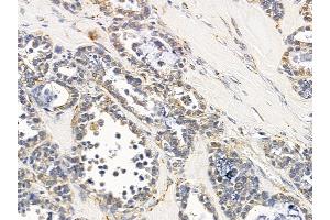 ABIN6258026 and ABIN6275228 at 1/100 staining human ovarian cancer by IHC-P. (CLNS1A Antikörper  (C-Term))