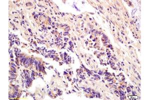 Formalin-fixed and paraffin embedded human colon carcinoma labeled with Anti-ompF(putative outer membrane porin F protein) Polyclonal Antibody, Unconjugated  at 1:200 followed by conjugation to the secondary antibody and DAB staining. (Ompf (AA 171-213) Antikörper)