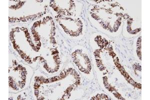 IHC-P Image Immunohistochemical analysis of paraffin-embedded human endo mitral ovarian cancer, using KRT18, antibody at 1:100 dilution. (Cytokeratin 18 Antikörper)