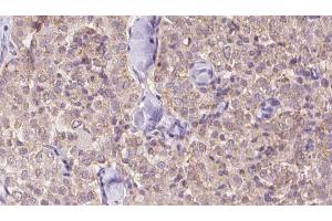 ABIN6273342 at 1/100 staining Human thyroid cancer tissue by IHC-P. (USP9X Antikörper  (N-Term))