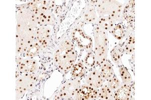 ABIN6267542 at 1/200 staining human kidney carcinoma tissue sections by IHC-P.