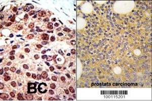 Formalin-fixed and paraffin-embedded human prostata carcinoma tissue reacted with PRMT3 Antibody (C-term) (ABIN387839 and ABIN2843941) , which was peroxidase-conjugated to the secondary antibody, followed by DAB staining. (PRMT3 Antikörper  (C-Term))
