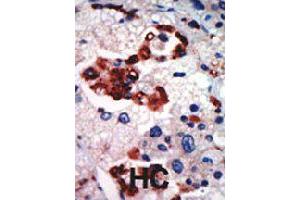 Formalin-fixed and paraffin-embedded human hepatocellular carcinoma tissue reacted with PRKCI polyclonal antibody  , which was peroxidase-conjugated to the secondary antibody, followed by AEC staining . (PKC iota Antikörper  (N-Term))