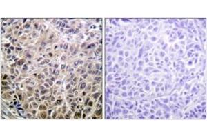 Immunohistochemistry analysis of paraffin-embedded human liver carcinoma tissue, using DAPK1 (Ab-308) Antibody. (DAP Kinase 1 Antikörper  (AA 274-323))