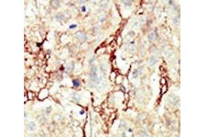IHC analysis of FFPE human breast carcinoma tissue stained with the FGFR3 antibody (FGFR3 Antikörper  (AA 776-806))
