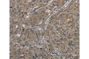 Immunohistochemistry of Human gastric cancer using CLPS Polyclonal Antibody at dilution of 1:40 (CLPS Antikörper)