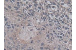 Detection of TGFb3 in Human Lung cancer Tissue using Monoclonal Antibody to Transforming Growth Factor Beta 3 (TGFb3)