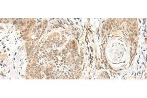 Immunohistochemistry of paraffin-embedded Human esophagus cancer tissue using GPSM1 Polyclonal Antibody at dilution of 1:55(x200) (GPSM1 Antikörper)