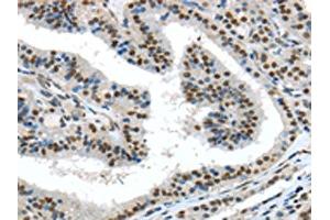 The image on the left is immunohistochemistry of paraffin-embedded Human thyroid cancer tissue using ABIN7131359(TKT Antibody) at dilution 1/30, on the right is treated with fusion protein. (TKT Antikörper)