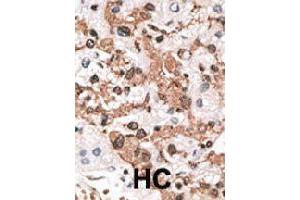 Formalin-fixed and paraffin-embedded human hepatocellular carcinoma tissue reacted with KCNIP3 polyclonal antibody  , which was peroxidase-conjugated to the secondary antibody, followed by AEC staining.