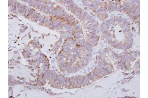 IHC-P Image Immunohistochemical analysis of paraffin-embedded human colon carcinoma, using LYN, antibody at 1:250 dilution.