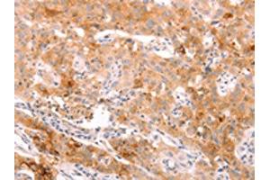 The image on the left is immunohistochemistry of paraffin-embedded Human lung cancer tissue using ABIN7189783(ALPPL2 Antibody) at dilution 1/20, on the right is treated with synthetic peptide. (ALPPL2 Antikörper)