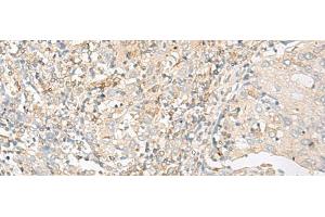 Immunohistochemistry of paraffin-embedded Human cervical cancer tissue using GLIS1 Polyclonal Antibody at dilution of 1:50(x200) (GLIS1 Antikörper)