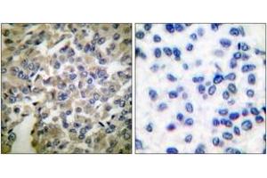 Immunohistochemistry analysis of paraffin-embedded human breast carcinoma tissue, using Synaptotagmin (Ab-309) Antibody. (Synaptotagmin Antikörper  (AA 276-325))