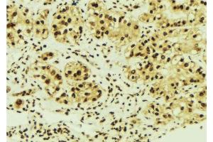ABIN6276334 at 1/100 staining Human breast cancer tissue by IHC-P.